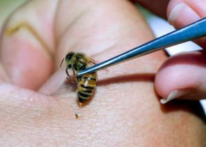 Особенности лечения суставов пчелиными укусами